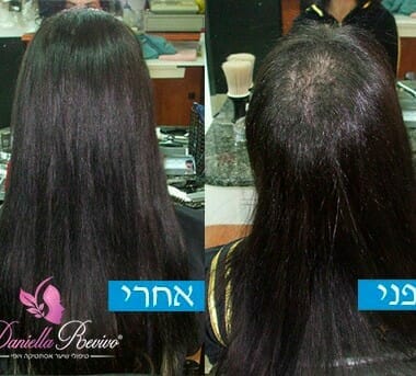 טיפול לשיער דליל בקרב נשים