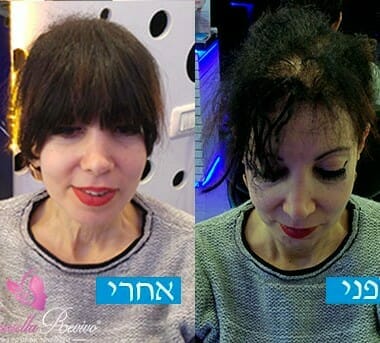 לפני ואחרי עיבוי שיער